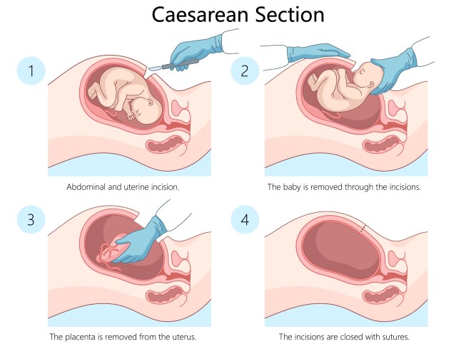 Caesarean Delivery