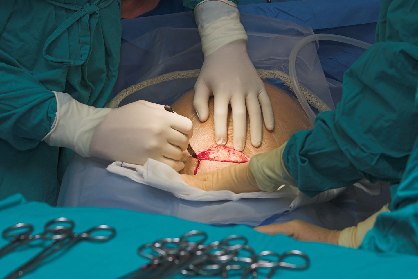 Caesarean section