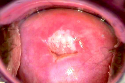 Cancer Screening (Pap Smear, VIA, Colposcopy)