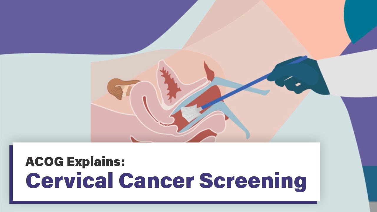 Cervical cancer screening advice