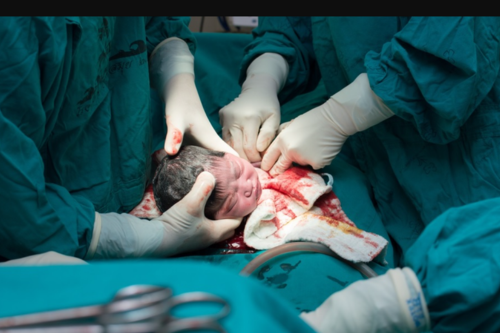 Cesarean Section (LSCS)