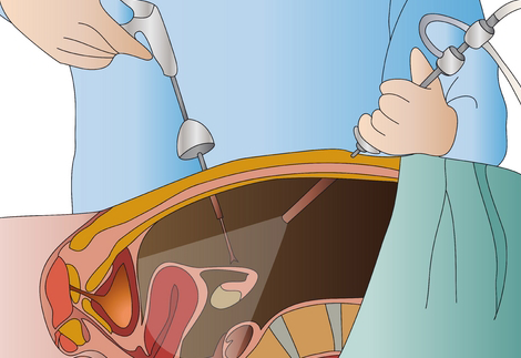 Endometriosis Surgery