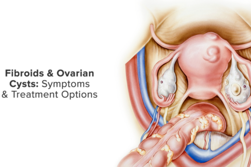 Fibroid & Cyst Removal