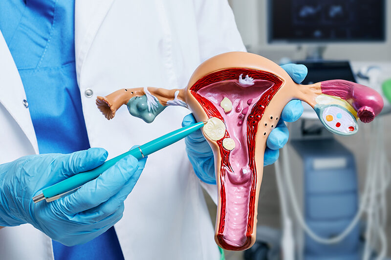 Fibroid removal planning