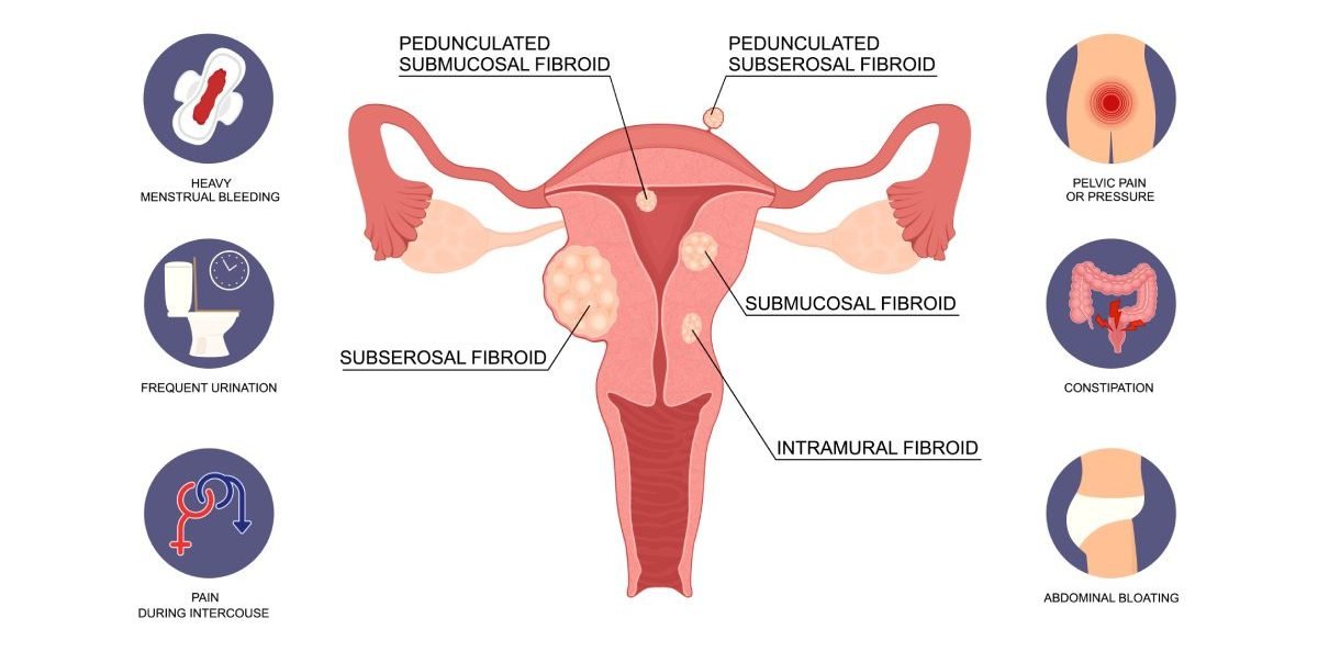 Fibroid treatment planning