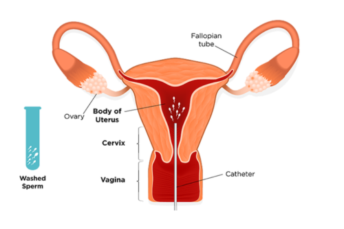 Intrauterine Insemination (IUI)