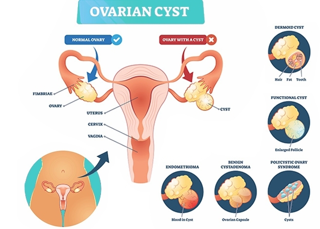 Ovarian cyst management