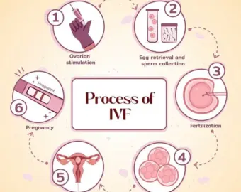 Stepwise fertility treatment planning