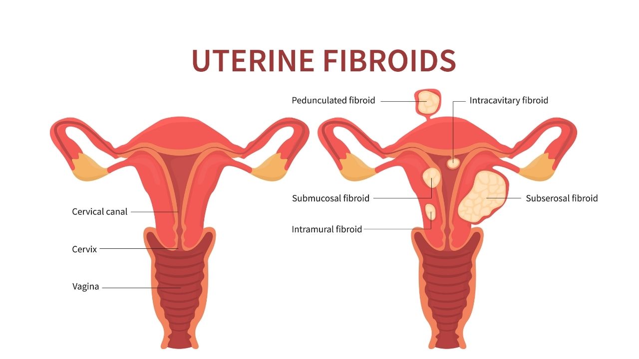Best doctor for fibroids In Nagpur