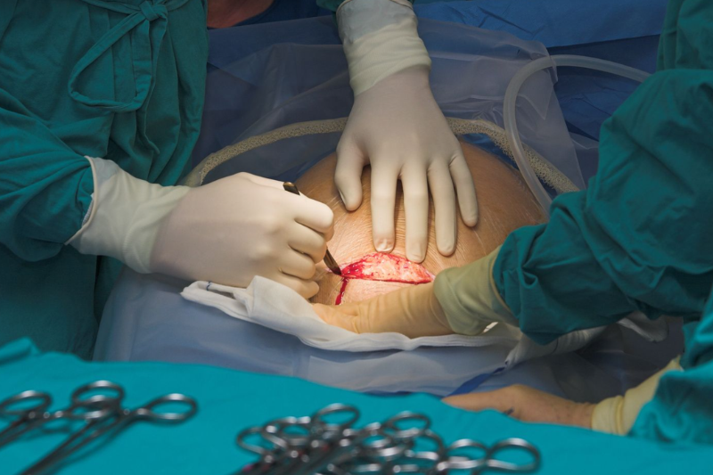 Caesarean section