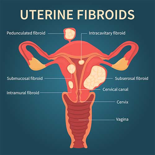 Fibroid Treatment In Nagpur