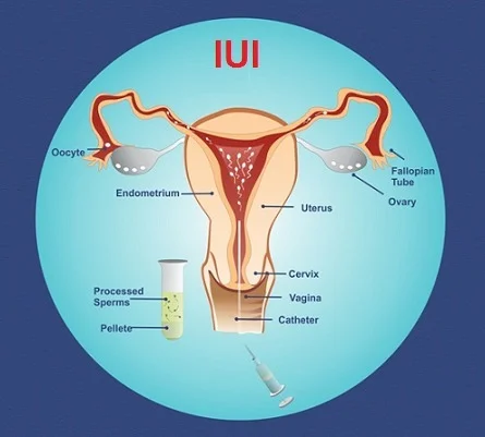IUI Specialist In Nagpur