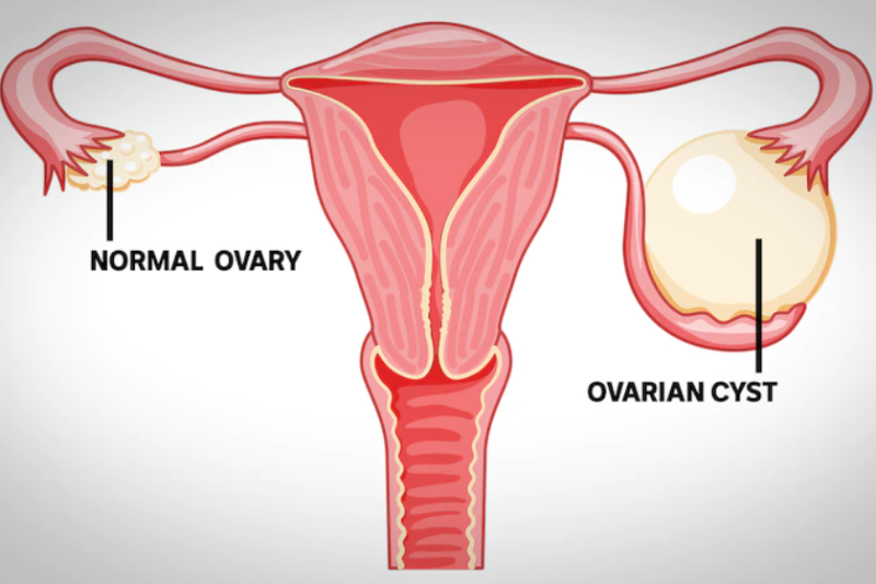 Ovarian cyst management