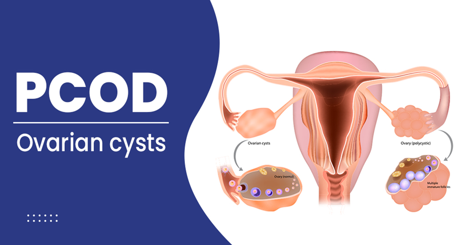 PCOD Treatment In Nagpur